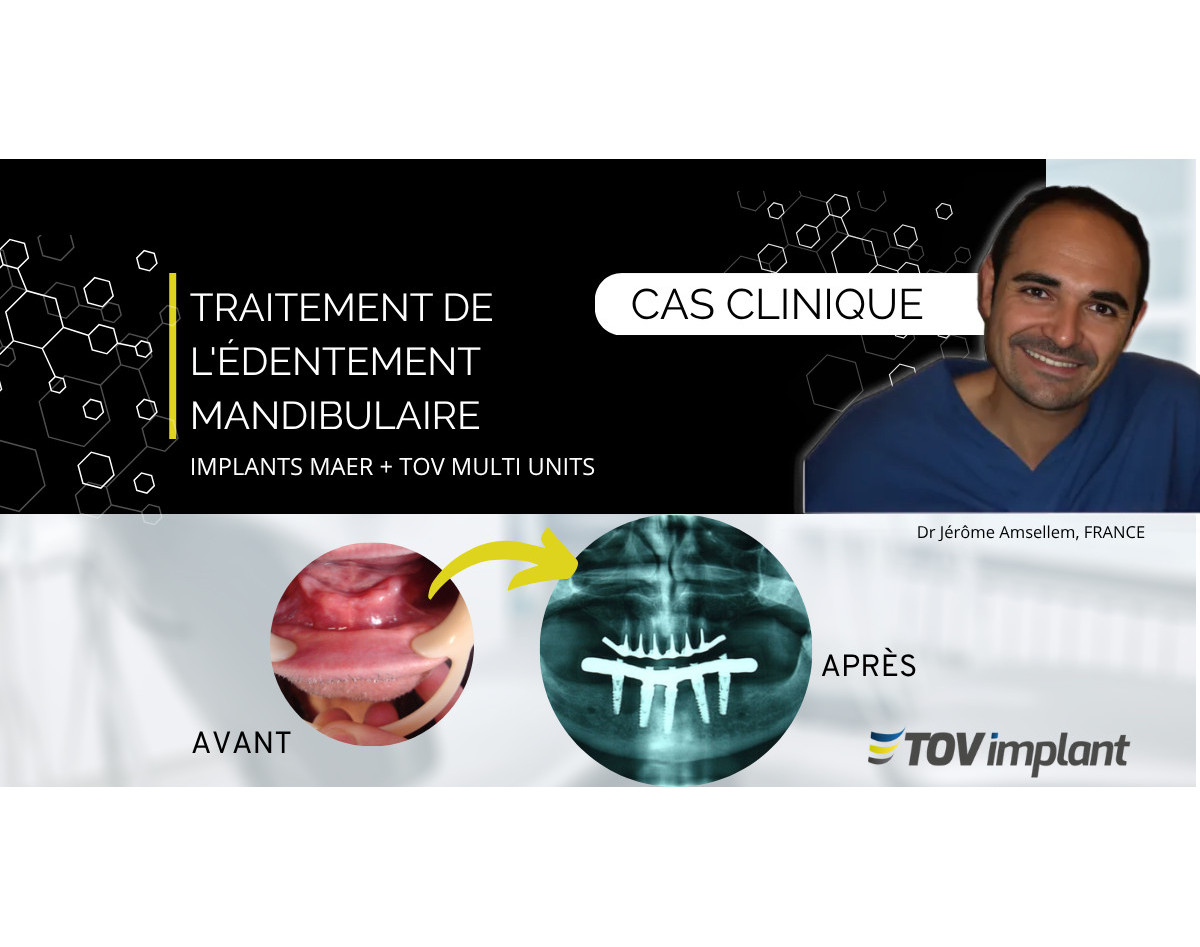 Réhabilitation mandibulaire avec implants MAER et piliers Multi-Unit TOV Implant